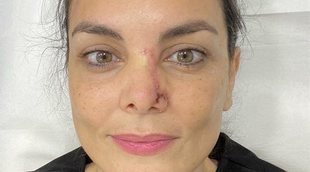 Mónica Carrillo revela que padece cáncer de piel