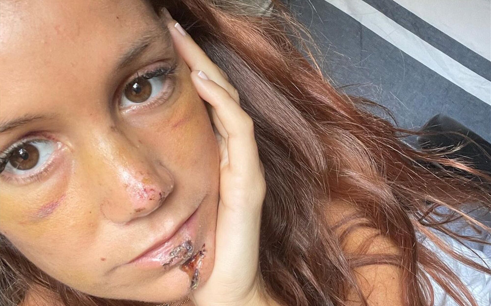 Miri Pérez-Cabrero ('MasterChef') enseña su rostro lleno de heridas días después del accidente de moto
