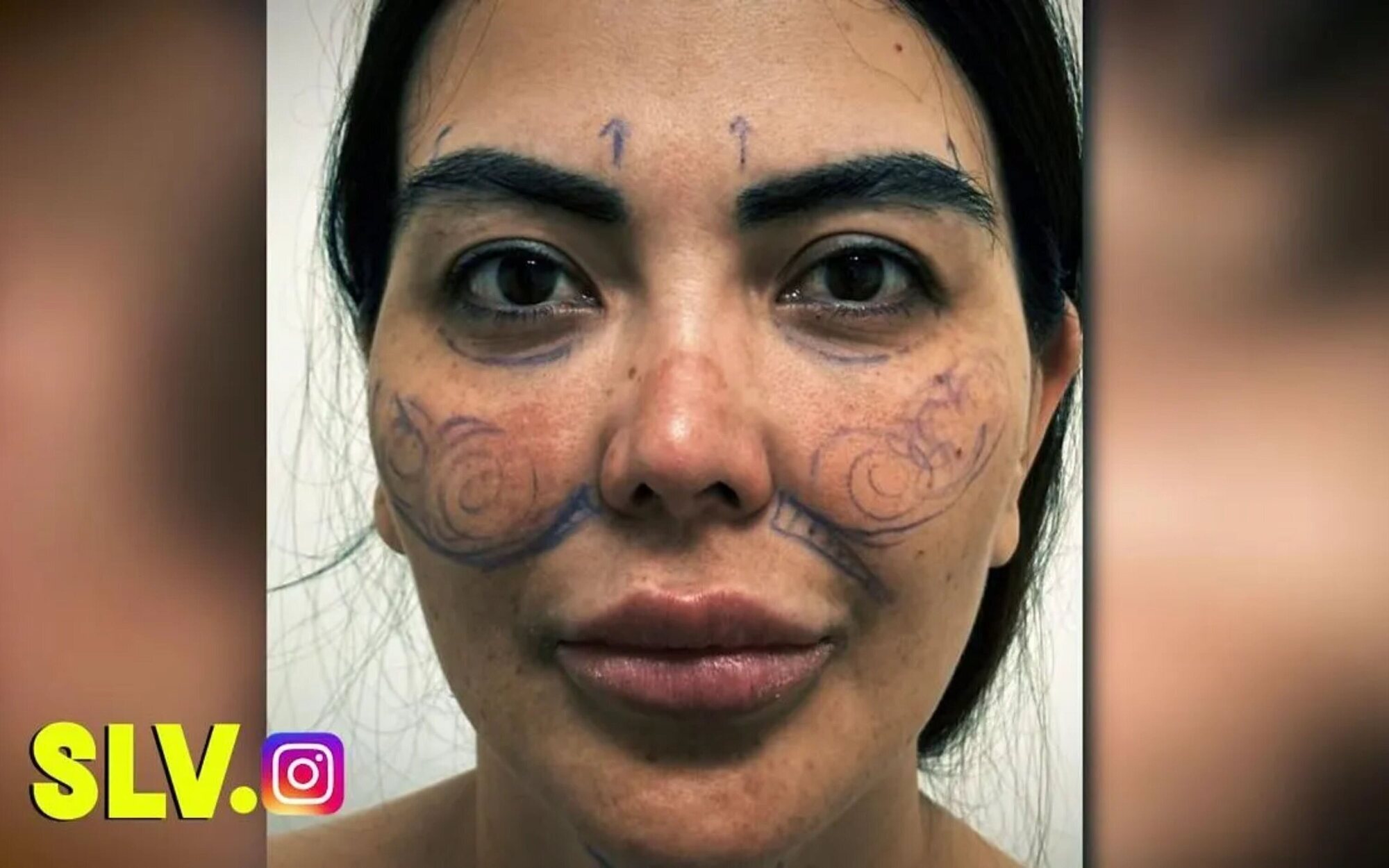 El desorbitado coste de la operación de Patricia Donoso para remodelar su cara
