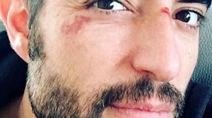 Dani Mateo ('El intermedio') muestra una imagen con varios rasguños en la cara y confiesa: "¡Qué torpe soy!"