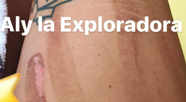 Alyson Eckmann sorprende en las redes con su herida