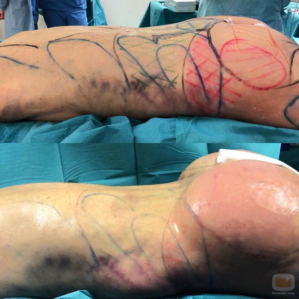 El culo de Leticia Sabater, antes y después de su operación