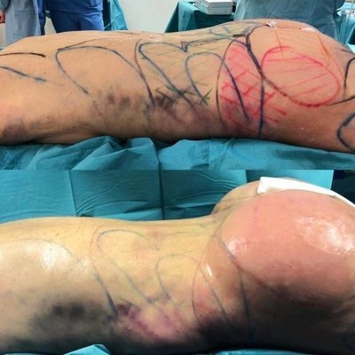 El culo de Leticia Sabater, antes y después de su operación