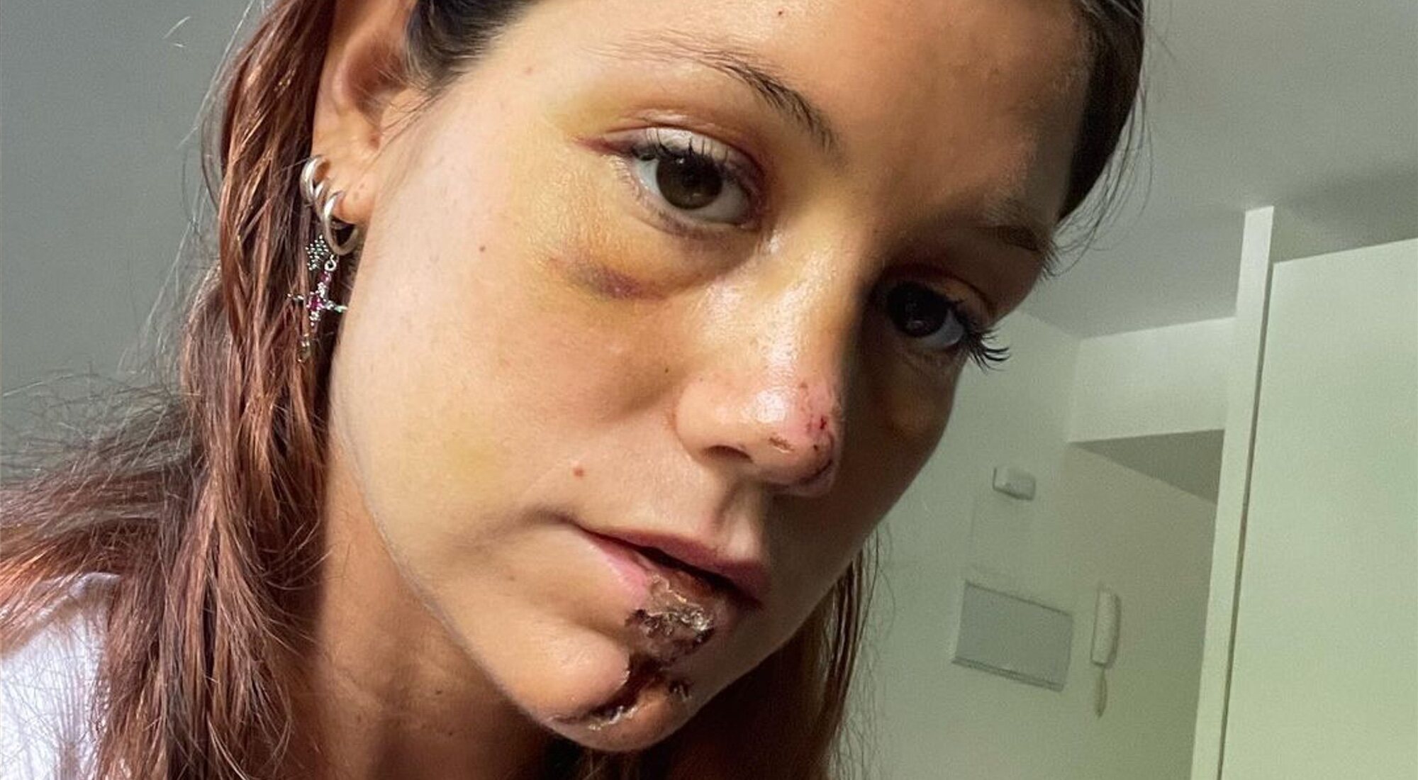 Miri Pérez-Cabrero, tras sufrir un accidente de moto