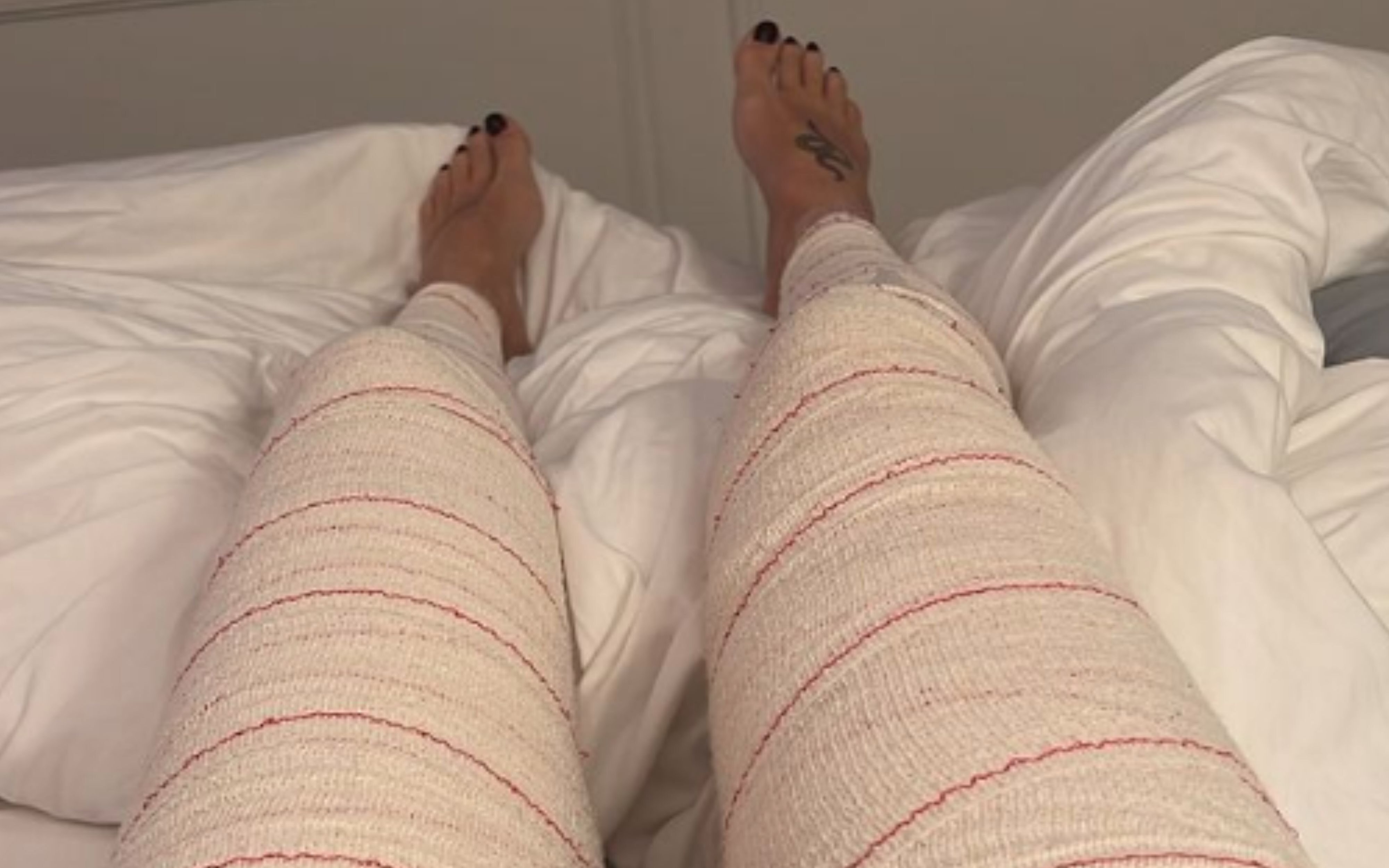 Las piernas vendadas de Adara Molinero en el hospital