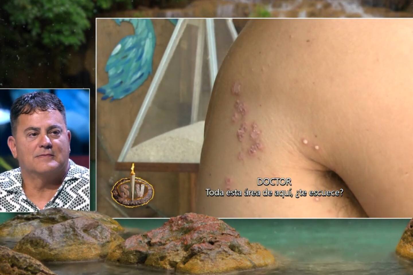 &#39;Supervivientes 2025&#39; muestra las erupciones en la piel de Joshua