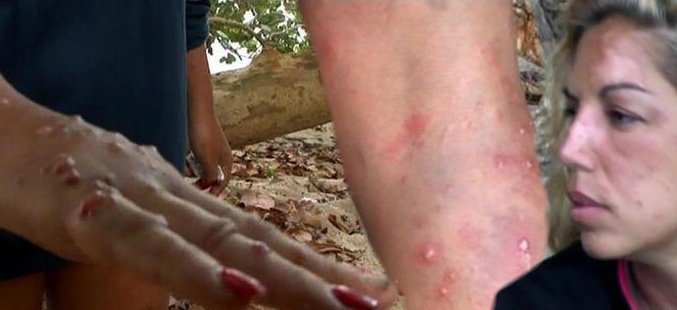 Rebeca Pous acribillada por los mosquitos en 'Supervivientes'