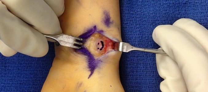 Fotografía de Miley Cyrus en Instagram enseñando su muñeca