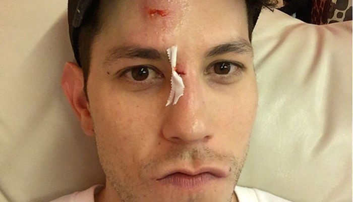 Christian Chávez sufre un accidente que le produce varias heridas en la cara