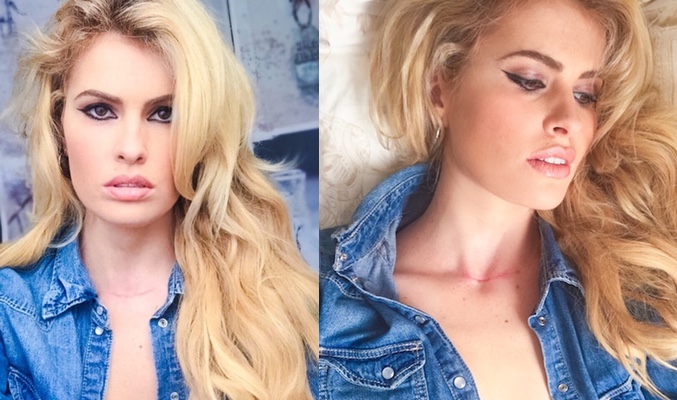 Adriana Abenia muestra la cicatriz de su cuello