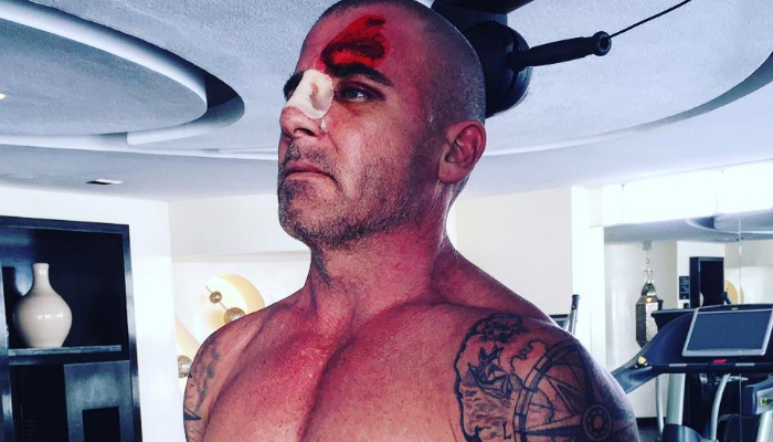 Dominic Purcell enseña las heridas que le causaron el accidente.