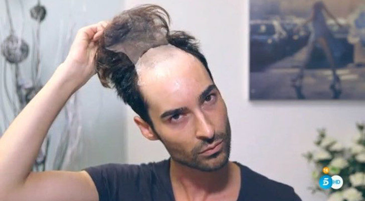 Miguel debe cambiarse su prótesis capilar cada siete días