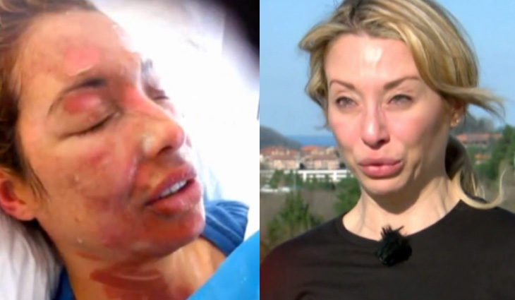 Laila sufrió hace un tiempo un accidente en cocina que le provocó graves secuales físicas que todavía recuerda