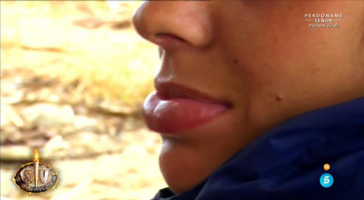 El labio hinchado de Laura