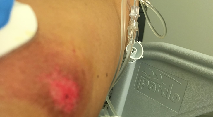 Heridas en el brazo de Mari Cielo