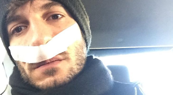 Quim Gutiérrez tras someterse a una operación de nariz