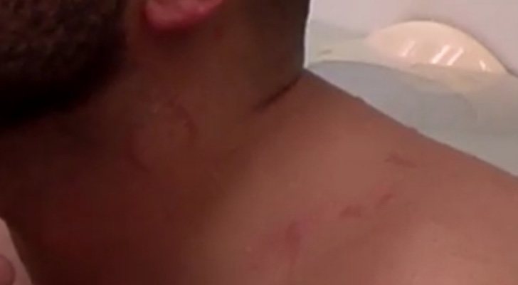 Marcas en el cuello de Antonio Tejado