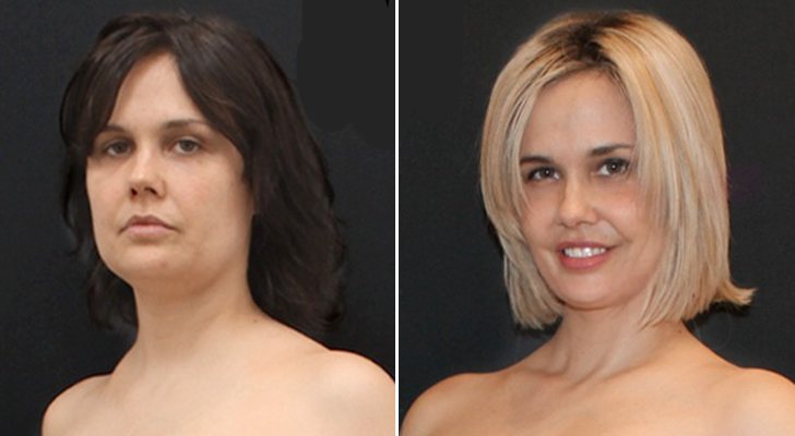 Miriam Sánchez antes y después de sus operaciones de cirugía estética