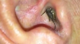 Impactante video viral en el que a un hombre le sale una araña de su oído